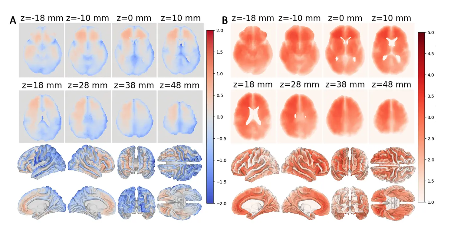 Right Brain Shows Faster Signs of Aging Than Left Side